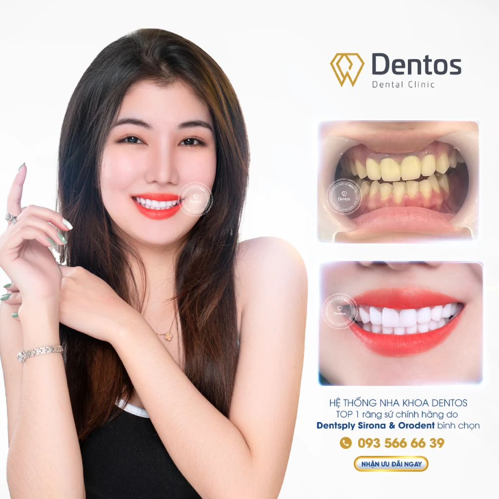 Nhiều khách hàng phải bọc răng sứ lại vì đen viền nướu